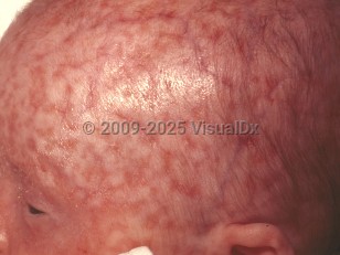 Clinical image of Neonatal lupus erythematosus - imageId=102924. Click to open in gallery.  caption: 'Confluent white papules, forming plaques that cover most of the scalp.'