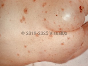 Clinical image of Generalized vaccinia - imageId=1039733. Click to open in gallery.  caption: 'Numerous large vesicles, many crusted, and some interspersed crusts on the back and buttocks.'