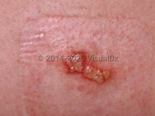 Clinical image of Herpes simplex virus - imageId=111180. Click to open in gallery.  caption: 'A close-up of grouped cloudy vesicles on an erythematous base.'