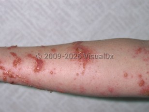 Poison ivy, oak, sumac dermatitis