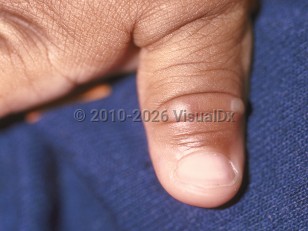 Hand, foot, and mouth disease