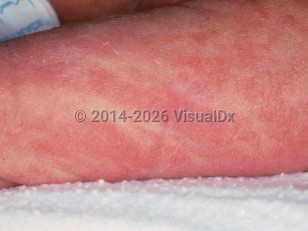 Clinical image of Incontinentia pigmenti - imageId=119964. Click to open in gallery.  caption: 'The vesicular stage, showing patterned erythematous plaques and fine vesiculation on the arm.'