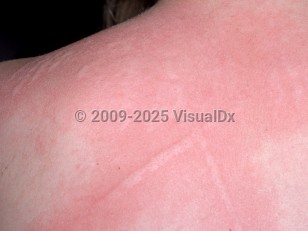 Clinical image of Dermographism - imageId=1308870. Click to open in gallery.  caption: 'Linear pink, edematous plaques with surrounding pink erythema on the back, with similar papules (hives) in the vicinity.'