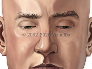 Illustration image of Botulism - imageId=1314097. Click to open in gallery. 