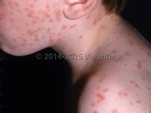 Clinical image of Urticaria pigmentosa - imageId=1316038. Click to open in gallery.  caption: 'Myriad red-brown macules and papules on the face, neck, and back.'
