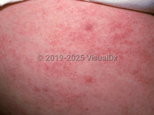Clinical image of Telangiectasia macularis eruptiva perstans - imageId=1326196. Click to open in gallery.  caption: 'Numerous telangiectatic macules and patches on the thigh with 3 small wheals (positive Darier sign).'