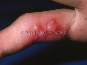 Herpetic whitlow