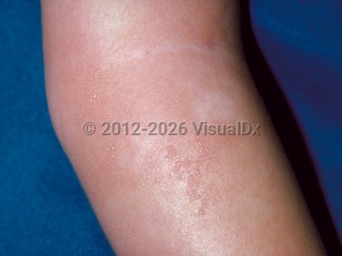 Clinical image of Eosinophilic cellulitis - imageId=138734. Click to open in gallery.  caption: 'A large, vesiculated, edematous pink plaque on the arm.'