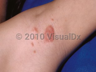 Inverse psoriasis