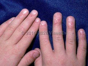 Dyskeratosis congenita