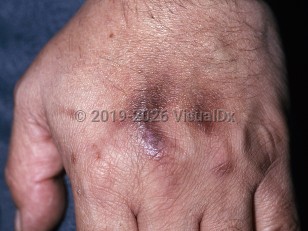 Clinical image of Drug-induced pigmentation - imageId=152129. Click to open in gallery.  caption: 'Brown and violaceous macules and patches on the dorsal hands developing secondary to minocycline.'