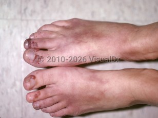 Granulomatosis with polyangiitis