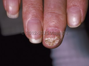 Clinical image of Onychomycosis - imageId=153756. Click to open in gallery.  caption: 'Thickened fourth fingernail with distal loss of nail and subungual hyperkeratosis.'