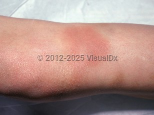 Clinical image of Von Willebrand disease - imageId=1556415. Click to open in gallery.  caption: 'Erythematous and ecchymotic plaques on the leg.'