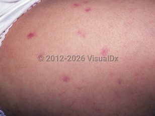 Clinical image of Aplastic anemia - imageId=1559435. Click to open in gallery.  caption: 'Purpuric macules on the thigh.'