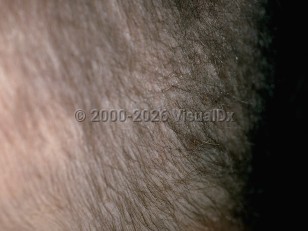 Clinical image of Monilethrix - imageId=156451. Click to open in gallery.  caption: 'Fine, wiry, broken-off scalp hair.'