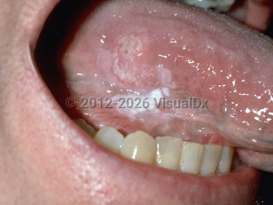 Clinical image of Oral squamous cell carcinoma - imageId=161727. Click to open in gallery.  caption: 'An ulcerated pink and white plaque on the lateral tongue.'