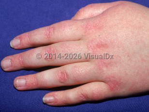 Clinical image of Juvenile dermatomyositis - imageId=1636572. Click to open in gallery.  caption: 'Faintly violaceous and erythematous papules and patches over the knuckles (atrophic dermal papules).'