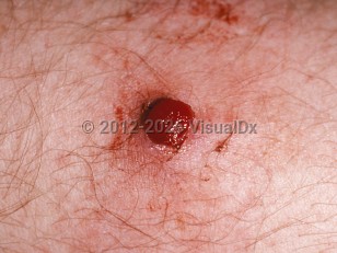 Clinical image of Lobular capillary hemangioma - imageId=163970. Click to open in gallery.  caption: 'A close-up of a well-demarcated bleeding papule.'