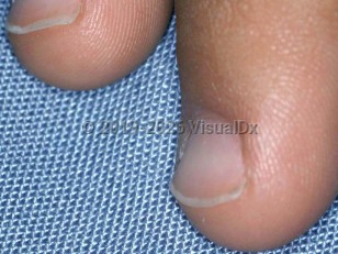 Iron deficiency anemia