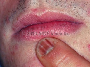 Clinical image of Laugier-Hunziker syndrome - imageId=1653517. Click to open in gallery.  caption: 'Longitudinal pigmented bands of a fingernail and grayish macules on the lower lip.'