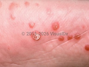 Reactive arthritis