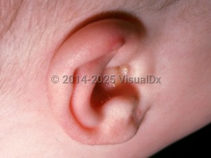 Clinical image of Subepidermal calcified nodule - imageId=1730361. Click to open in gallery.  caption: 'A white papule at the upper helix.'