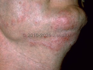 Tinea barbae