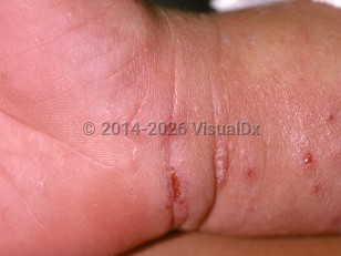 Scabies
