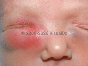 Clinical image of Neonatal dacryocystitis - imageId=1834943. Click to open in gallery.  caption: 'Marked infraorbital edema and erythema and milder similar supraorbital changes with overlying crusting on the right, and a smooth bluish papule on the left infraorbital skin.'