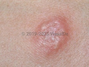 Clinical image of Brucellosis - imageId=1874956. Click to open in gallery. 