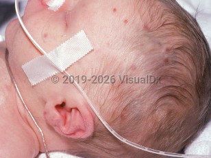 Clinical image of Congenital rubella - imageId=1896658. Click to open in gallery.  caption: 'Reddish and violaceous macules and papules on the head and ear ("blueberry muffin" lesions associated with cytomegalic inclusion disease).'