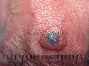 Clinical image of Milker's nodules - imageId=1917793. Click to open in gallery.  caption: 'A bulla on the dorsal hand with a mammillated surface and a central grayish crust.'