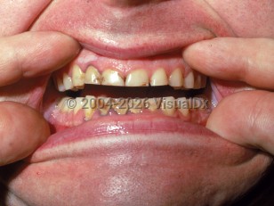 Lead poisoning