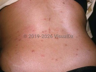 Mite dermatitis