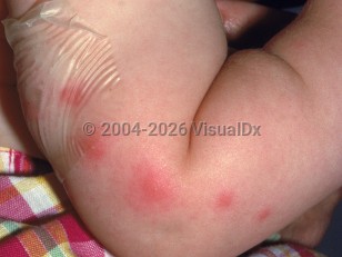 Clinical image of Papular urticaria - imageId=2040355. Click to open in gallery.  caption: 'Edematous, erythematous papules and plaques on the arm.'