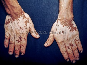 Clinical image of Pinta - imageId=2057099. Click to open in gallery.  caption: 'Depigmented macules and patches on the dorsal hands and fingers.'