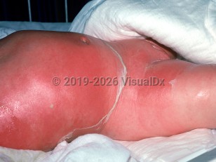 Clinical image of Staphylococcal scalded skin syndrome - imageId=2140314. Click to open in gallery.  caption: 'Diffuse bright red erythema with large areas of overlying peeling on the trunk and legs.'