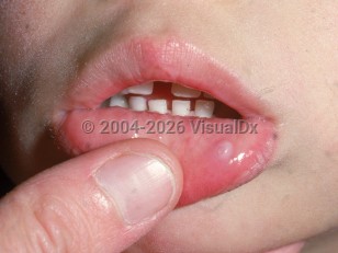 Clinical image of Oral mucocele - imageId=2177024. Click to open in gallery.  caption: 'A smooth gray-white papule on the lower labial mucosa.'