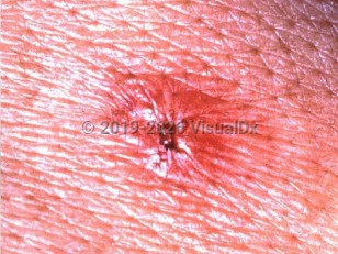 Japanese spotted fever
