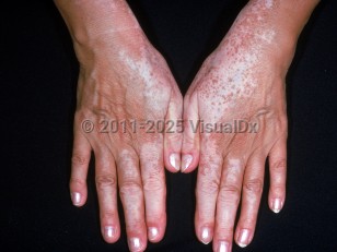 Clinical image of Drug-induced hypopigmentation - imageId=2200832. Click to open in gallery.  caption: 'Depigmented macules and patches on the dorsal hands, secondary to use of medication that was applied to the face.&nbsp;'