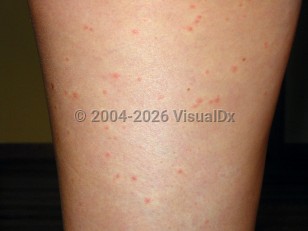 Clinical image of West Nile virus - imageId=2220835. Click to open in gallery.  caption: 'Numerous tiny, erythematous papules, each with a surrounding blanched halo, on the leg.<br/><br/>Image source: Centers for Disease Control and Prevention (CDC). This image is in the public domain and thus free of any copyright restrictions.'