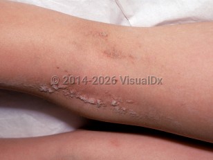 Clinical image of Keratinocytic epidermal nevus - imageId=2307735. Click to open in gallery.  caption: 'Scaly, verrucous papules and plaques following Blaschko lines on the leg.'