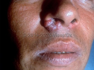 Clinical image of Rhinoscleroma - imageId=232127. Click to open in gallery.  caption: 'Confluent reddish papules forming a plaque at the inferior nostril.'