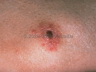 Clinical image of Tularemia - imageId=233146. Click to open in gallery.  caption: 'A close-up of an erythematous plaque with a central early eschar.'