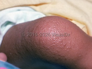 Cardiofaciocutaneous syndrome