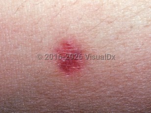 Clinical image of Multinucleate cell angiohistiocytoma - imageId=2377593. Click to open in gallery.  caption: 'A close-up of a reddish and violaceous papule.'