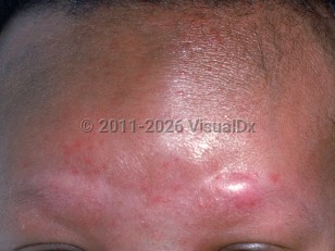 Clinical image of Congenital leukemia - imageId=2388686. Click to open in gallery.  caption: 'A shiny pink nodule over the eyebrow and unrelated papules of neonatal acne on the lower forehead.'