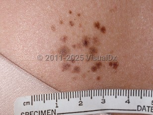 Clinical image of Agminated nevus - imageId=248880. Click to open in gallery.  caption: 'A close-up of a cluster of light and mid-brown macules and papules.'