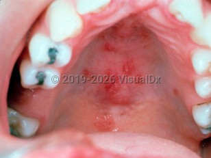Sjögren syndrome